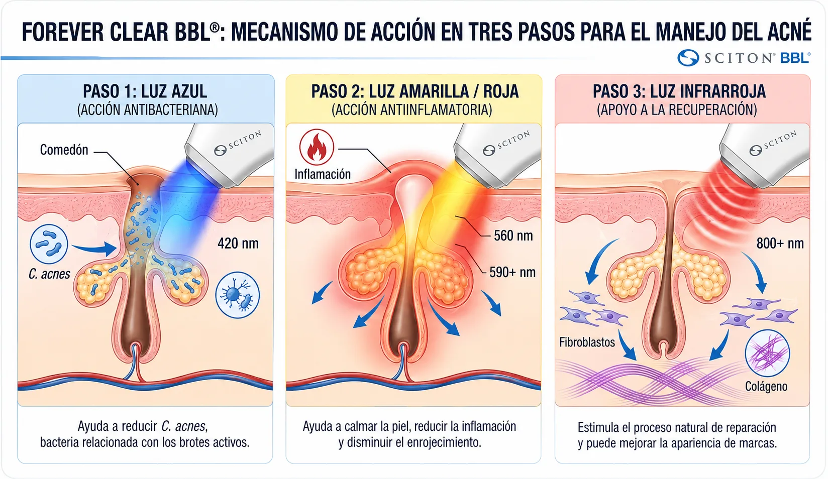 forever clear con tecnología bbl